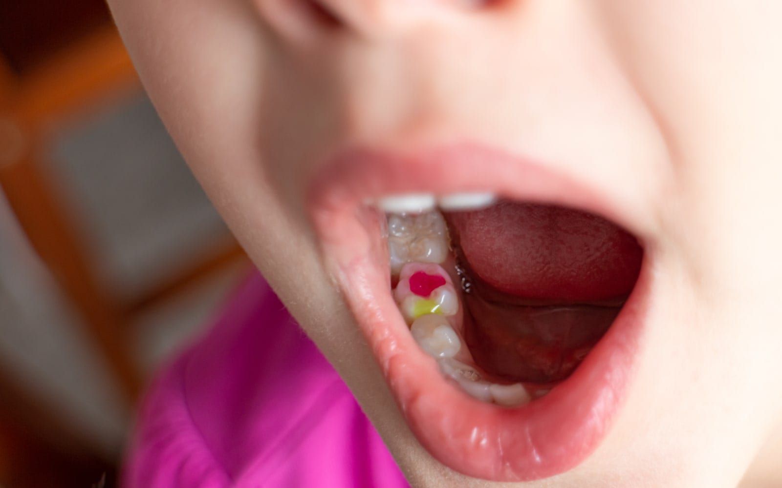 Efficient Dental filling for kids at palm valley Pediatric