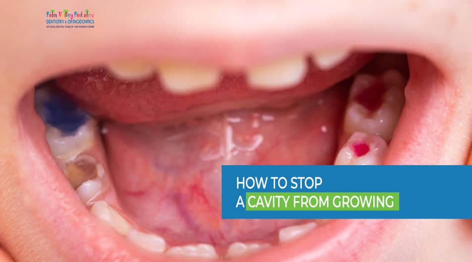 How to Stop a Cavity from Growing - Expert Tips for Prevention - PVPD