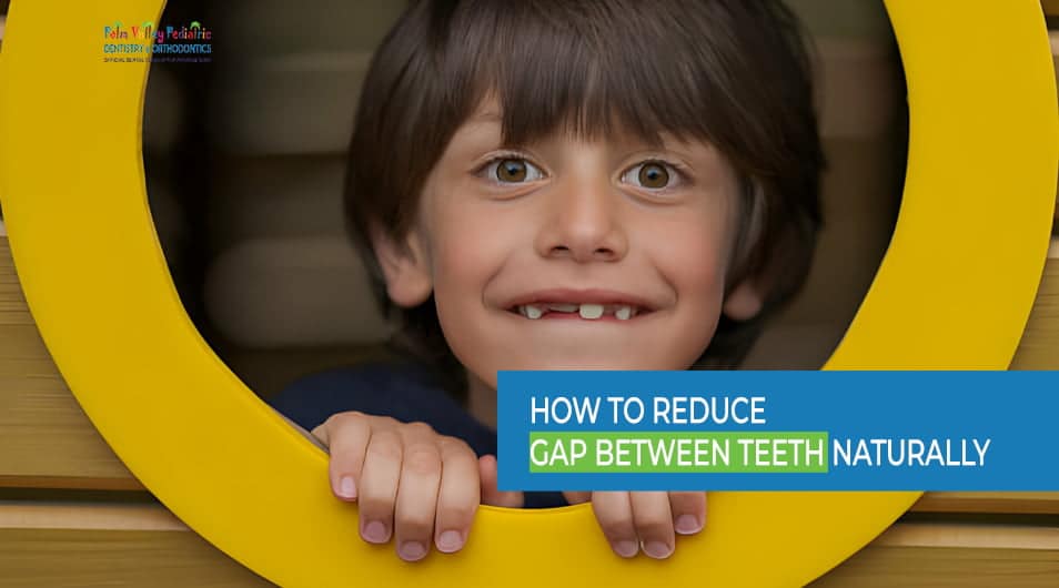 How to Reduce Gap Between Teeth Naturally at Home