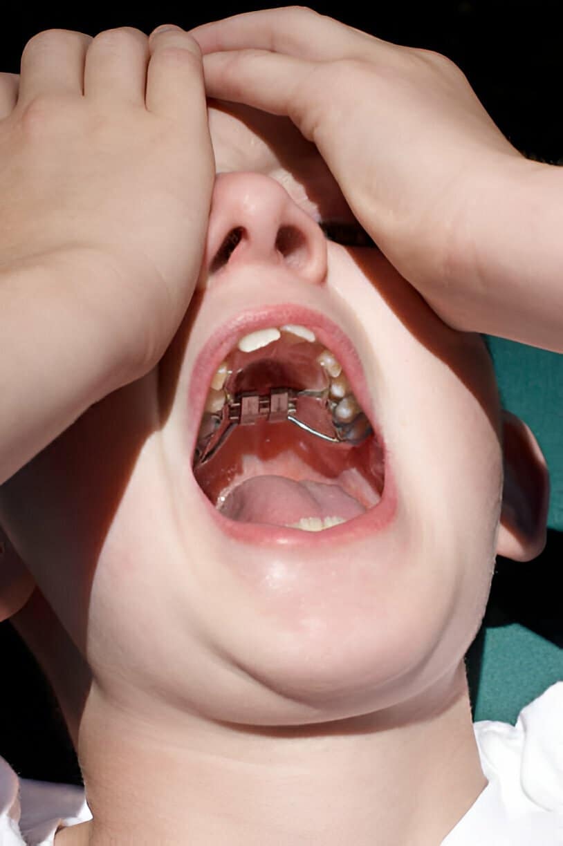 Baby-Boy-with-Palatal-Expander-Preparing-for-Adjustment.