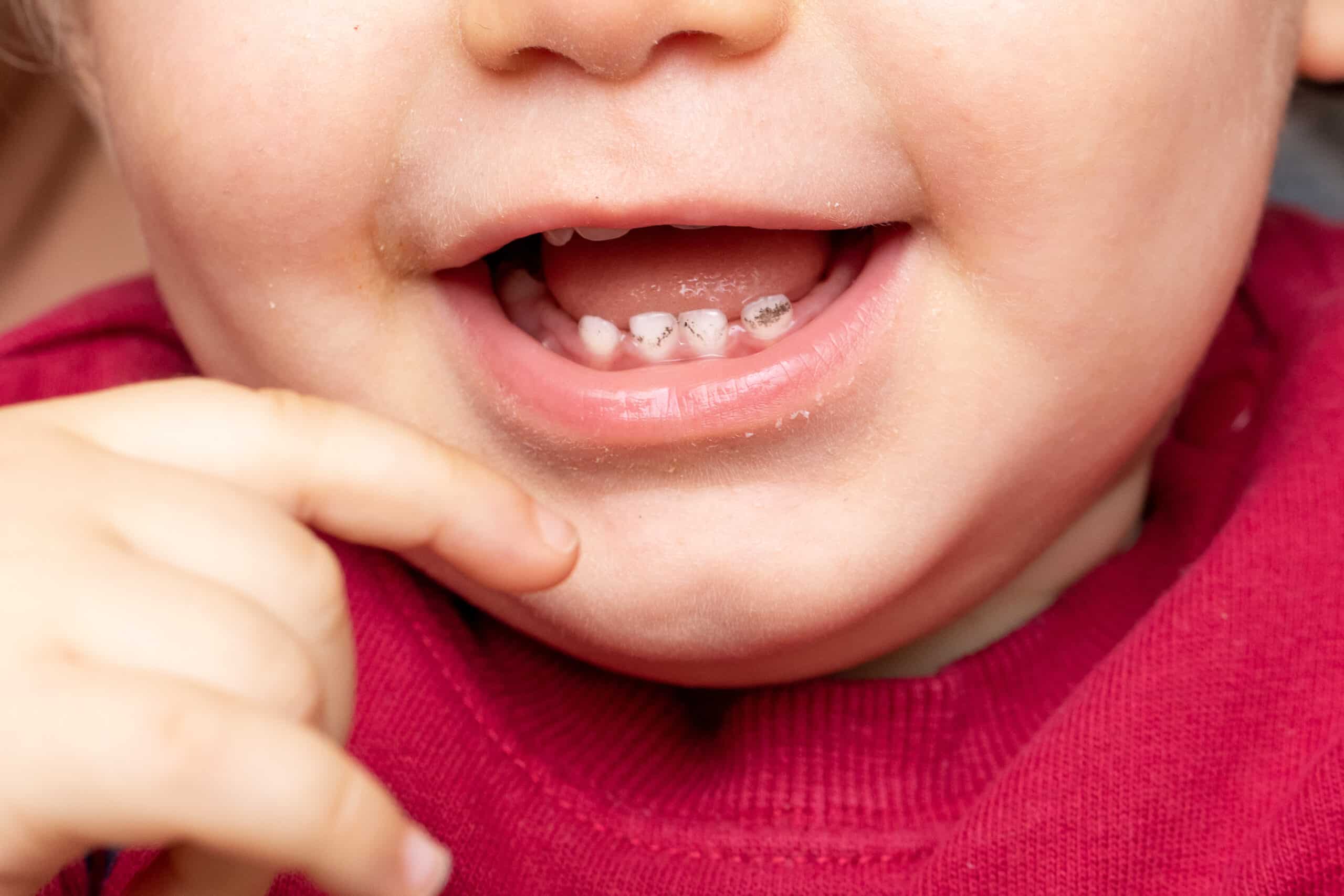 Close-up-of-baby-boys-open-mouth-with-black-mottled-incisors-from-Silver-Diamine-Fluoride-Treatment-scaled