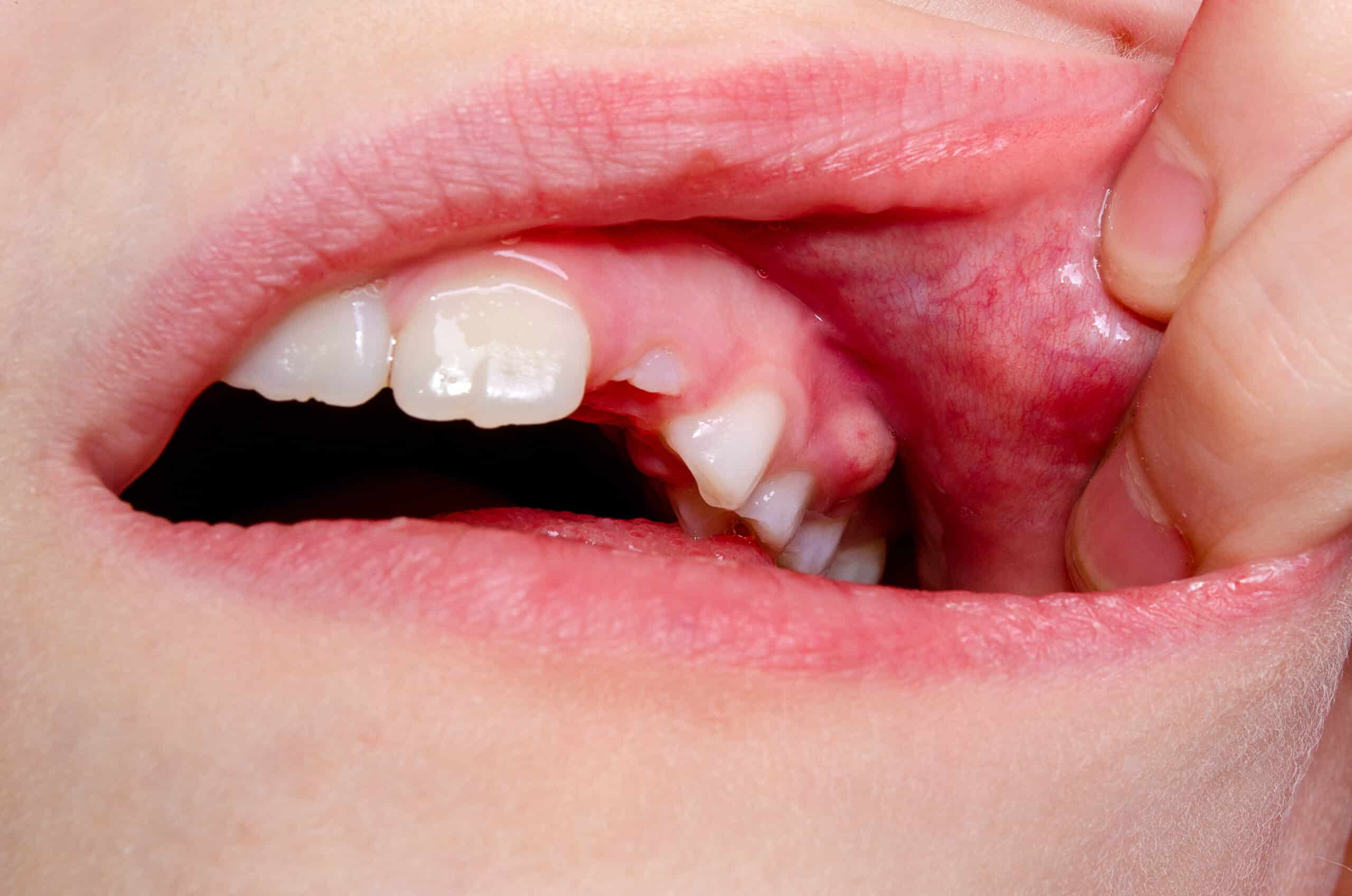 Dental-Abscess-Treatment-for-Children-in-Arizona-to-Prevent-Gum-Disease-and-Tooth-Decay-1-scaled