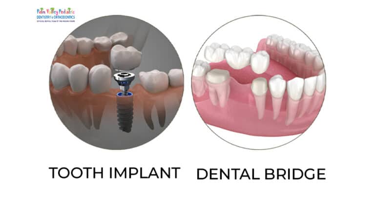Cantilever Dental Bridge: Procedure, Aftercare, Pros and Cons