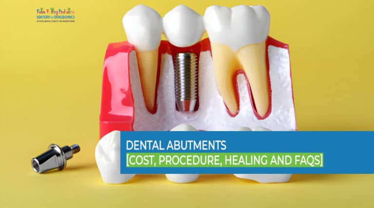 Cantilever Dental Bridge: Procedure, Aftercare, Pros and Cons