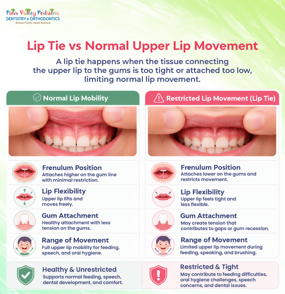 Infographic comparing lip tie and normal upper lip movement in children